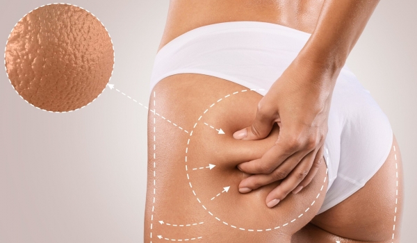 Celulite: Os melhores exercícios para combatê-las